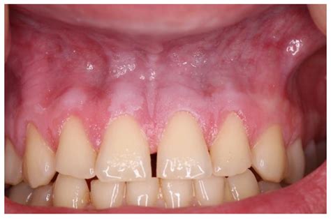 White Spots On Gums From Chewing Tobacco