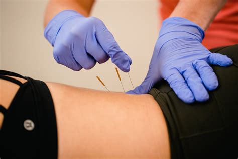 The Benefits of Dry Needling | ResilientRX