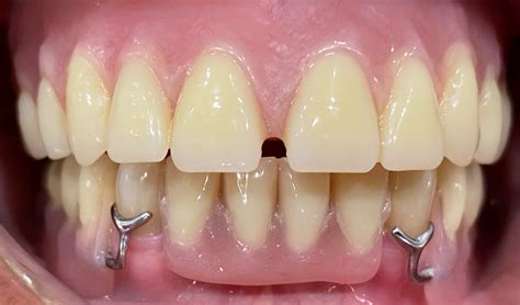 Partial Denture Fitting Process at Gemma Nock blog