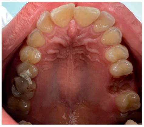 Unilateral Torus Mandibularis