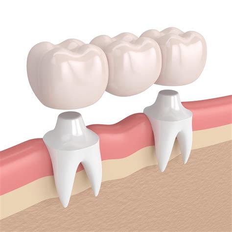 What Is A 3 Unit Dental Bridge at James Hillier blog
