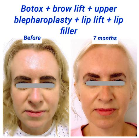 Upper Lip Botox Before And After