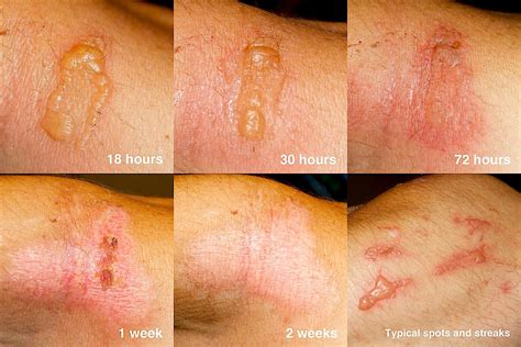 Poison Oak Rash Vs Poison Ivy Recognizing Poison Ivy, Oak And Sumac