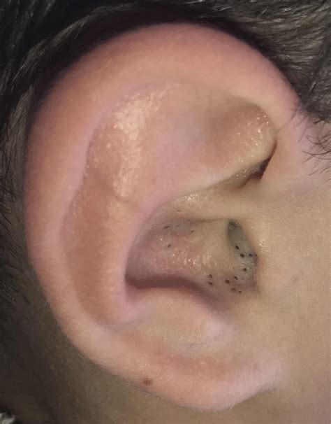 Blackheads In Ear