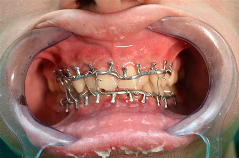 What Is Oral Fixation