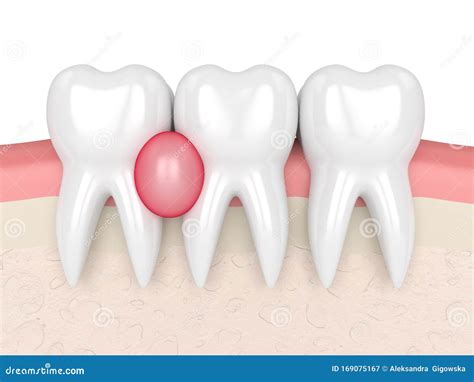 3d Render of Teeth in Gums with Cyst Stock Illustration - Illustration of cavity, cyst: 169075167