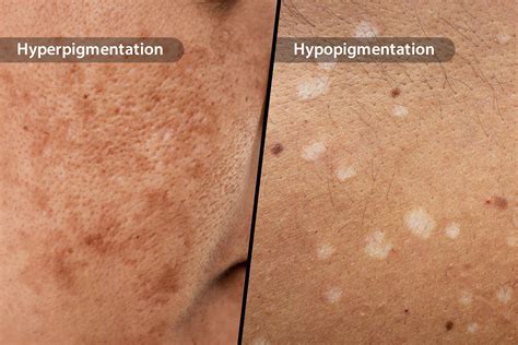 What Is Hyperpigmentation
