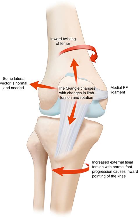 Pathological Torsion of the Lower Limb - Clinical Tree