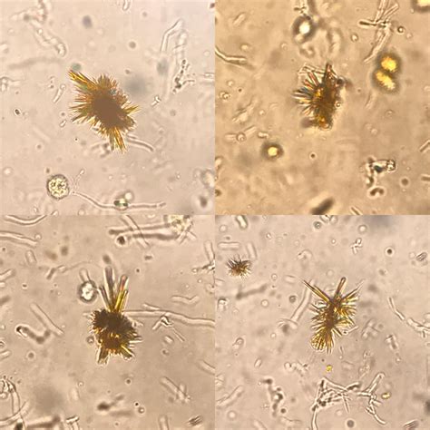Leucine Crystals In Urine Sediment