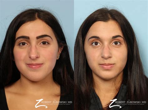 Rhinoplasty | Nose Surgery Dr. Zubowski | Paramus, Hoboken