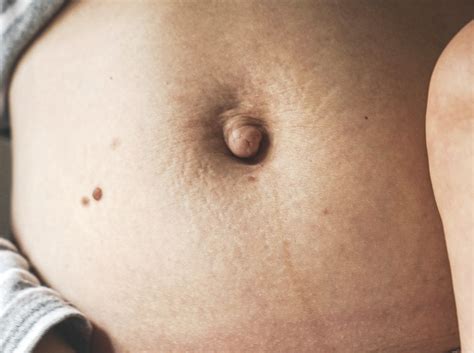 Umbilical Hernia & Belly Button Bulge Singapore | Ark Surgical