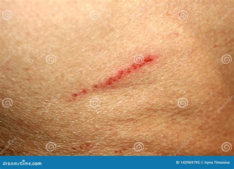 Wound Cut on the Skin. Abrasion on Human Skin. Stock Image - Image of ...