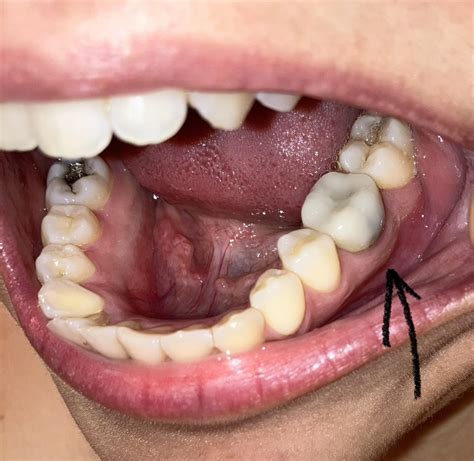 Is my crown infected? I occasionally get pulsating pain, had a root canal before the crown, and ...