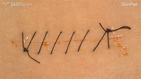 Simple Running Suture Technique. How to master it. | UpSurgeOn