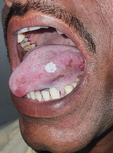White Zits On Tongue