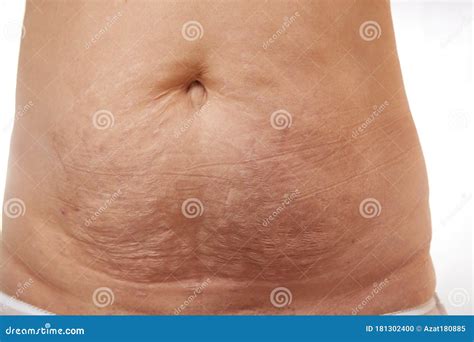 Belly of a 40 Year Old Woman with Postpartum Stretch Marks Close Up ...
