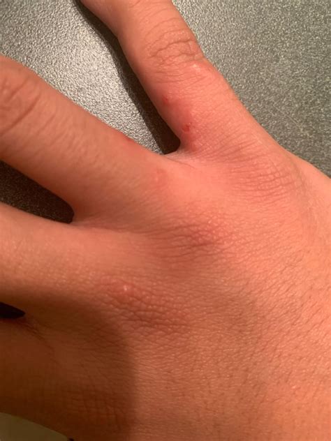Red itchy bumps on my hands what is it how do I get rid of it : r/Dermatology