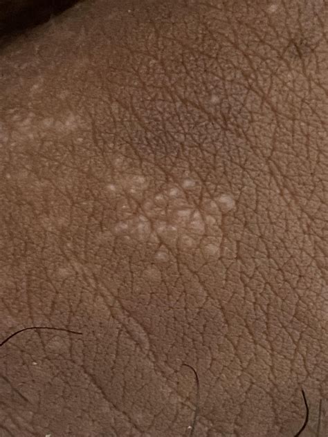 Is it Fordyce Spots or Genital Warts : r/STDFacts