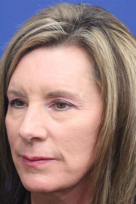 Endoscopic Face Lift Procedure at Alyssa Massy-greene blog