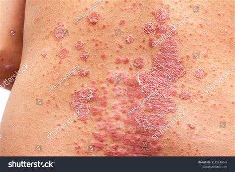 20 Eczema On Back Knees Images, Stock Photos & Vectors | Shutterstock
