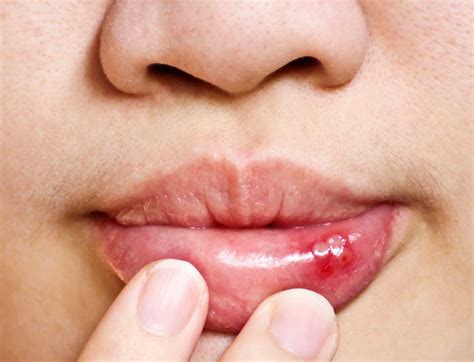 What Is Blood Blister In Mouth: Causes And Treatment