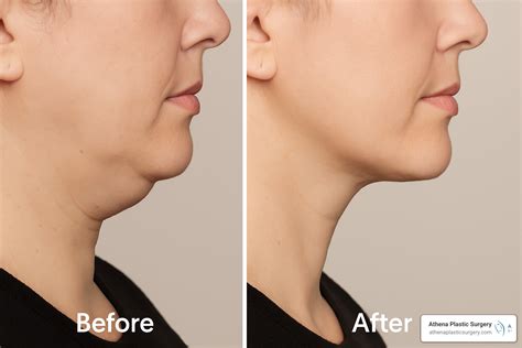 CoolSculpting Before and After: 10 Jaw-Dropping Results 2025