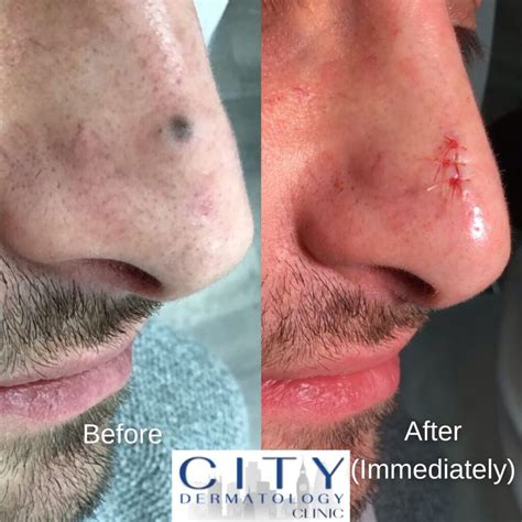 Can Moles Be Removed