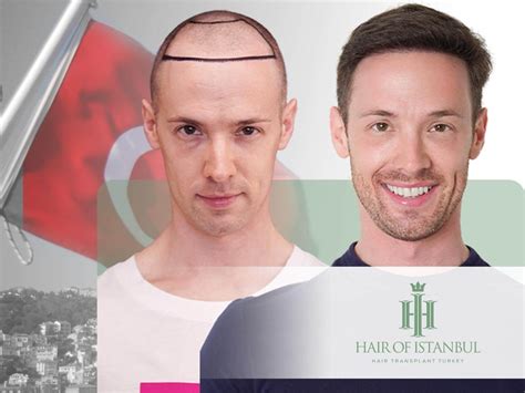 M-Shaped Hairline: The Ultimate Guide to Understanding