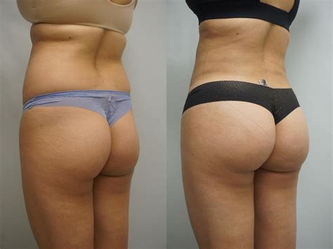 Plus size brazilian butt lift - felasem