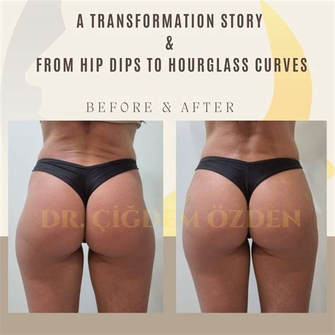Non-Surgical Butt Lift with Fillers & Liquid BBL in Istanbul - Turkey | Dr. Çiğdem Özden