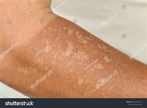 Sunburn Peeling Different Skin Colors