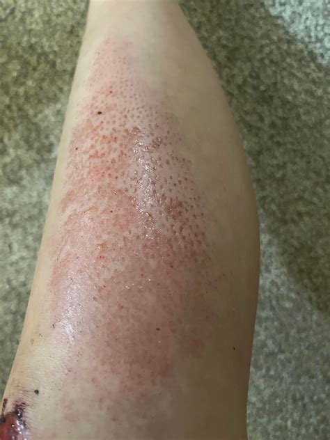 Why does my skin have these holes on it after I crashed on my longboard and scraped up my legs ...