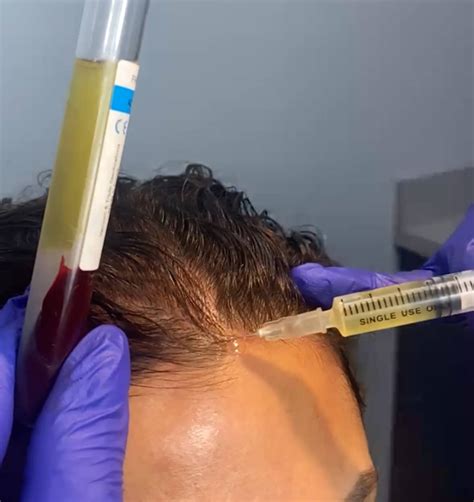 PRP Hair Restoration Treatment in Cortlandt | Hair Loss Treatment