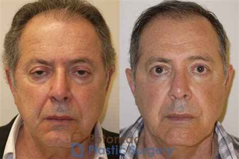 Brow Lift Before & After Photos Patient 78 | Washington DC & Arlington , DC | Potomac Plastic ...