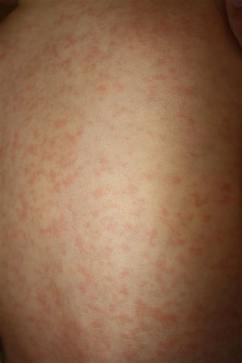 Fifths Disease Rash Pictures at Jared Harper blog