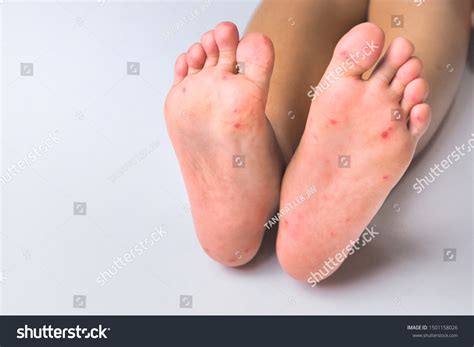 Red Rash On Feet From Ocean at Gregory Klink blog