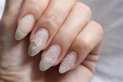 Acrylic Nail Fungus Symptoms