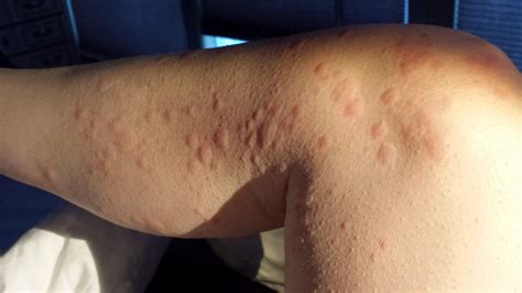 Tanning Bed Dermatitis at Noah Skye blog