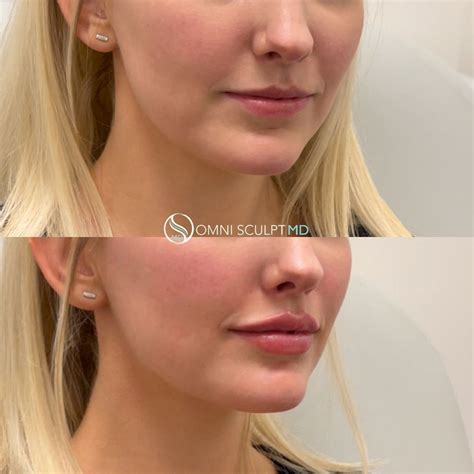 Lip filler before and after – Artofit
