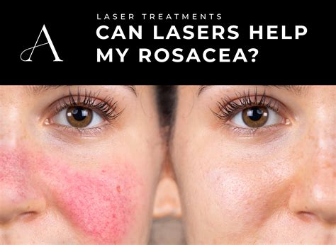 How Effective Is A Rosacea Laser Treatment For Your Skin? - Aesthetics ...