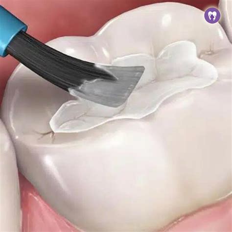 Protect Your Smile with Dental Sealants at RootCosmo