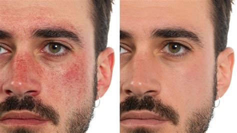 before-after-laser-redness-rosacea - Kopelson Clinic