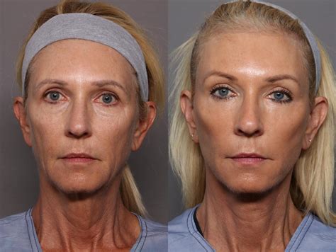 Facelift, Brow Lift, Blepharoplasty, Eyelid Lift, Kent V. Hasen, MD, Facial Rejuvenation in ...