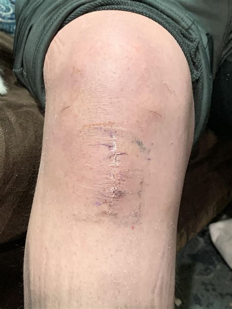 Osgood Schlatters In Adults Managing Osgood Schlatter Disease: Relief