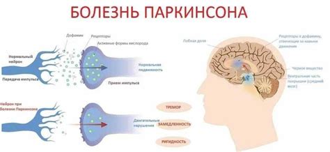 Как симптомы болезни Паркинсона влияют на прогноз жизни больного.