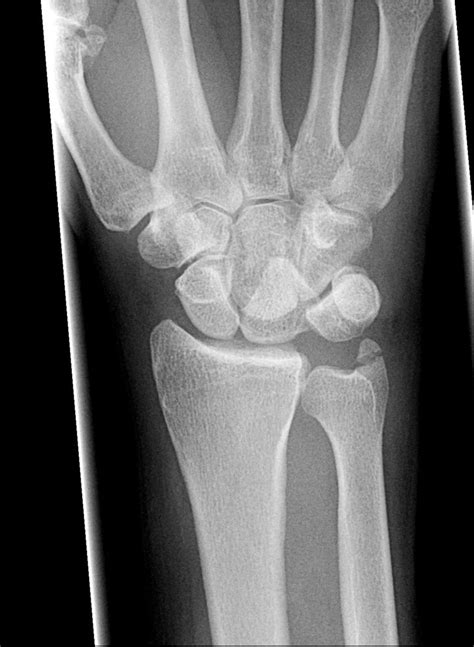 Normal Wrist X Ray Lateral