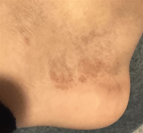 Brown spots on side of feet : r/AskDocs