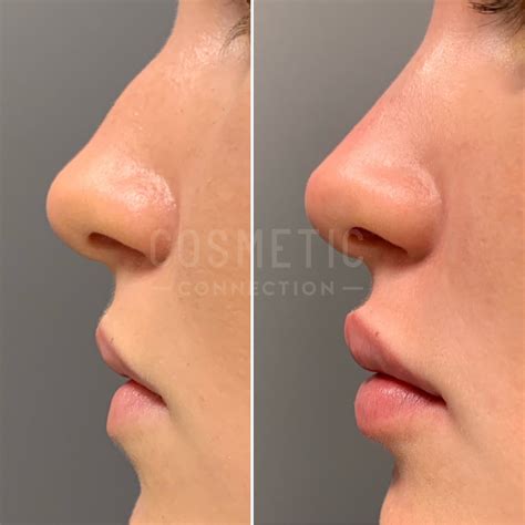 Perfect Nose Side Profile Achieving The Perfect Button Nose Shape