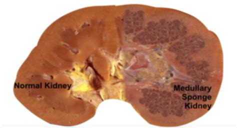 Medullary Sponge Kidney Nephrocalcinosis Ultrasound at Bobby Haley blog