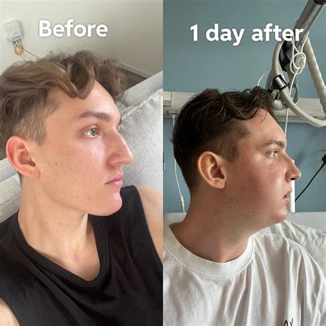jaw surgery while in college : r/jawsurgery